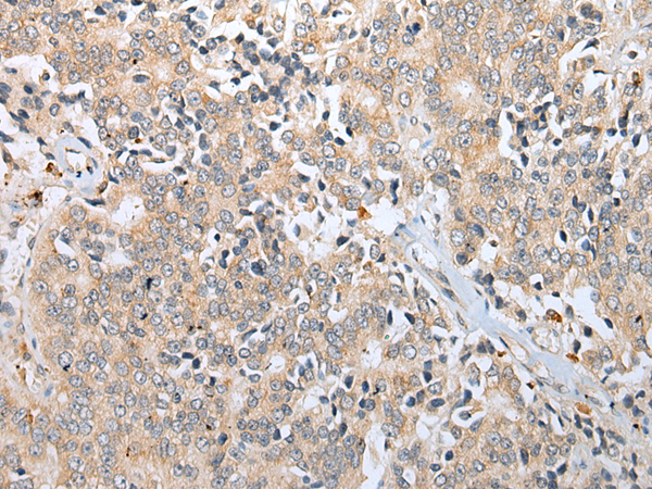 Immunohistochemistry of paraffin-embedded Human prostate cancer tissue using TA369585 (RFLNA Antibody) at dilution 1/30 (Original magnification: x200)