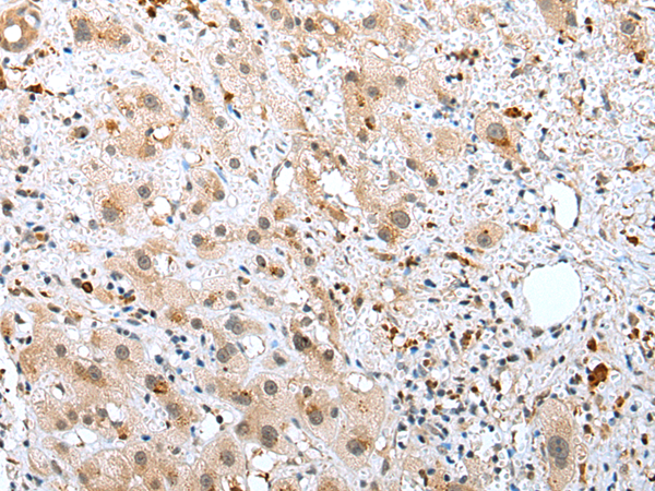 Immunohistochemistry of paraffin-embedded Human liver cancer tissue using TA369596 (RHOV Antibody) at dilution 1/25 (Original magnification: x200)