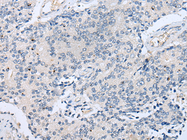 Immunohistochemistry of paraffin-embedded Human prostate cancer tissue using TA369630 (LYPD4 Antibody) at dilution 1/25 (Original magnification: x200)