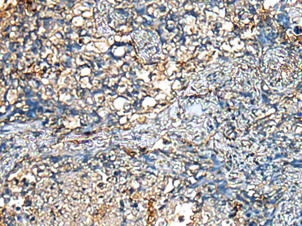 Immunohistochemistry of paraffin-embedded Human lung cancer tissue using TA369634 (PLA2G4D Antibody) at dilution 1/25 (Original magnification: x200)