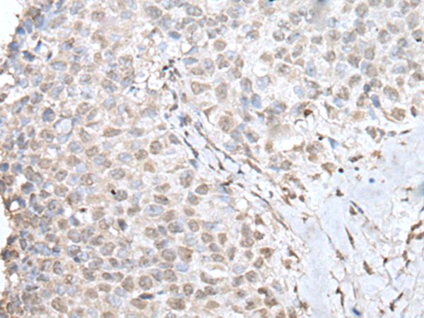 Immunohistochemistry of paraffin-embedded Human ovarian cancer tissue using TA369700 (ZNF207 Antibody) at dilution 1/30 (Original magnification: x200)