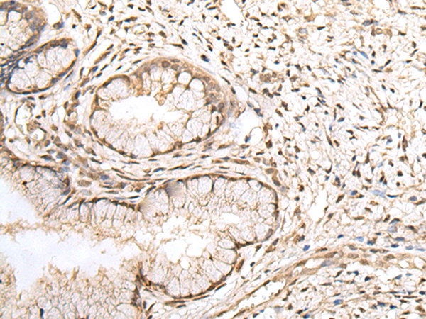 Immunohistochemistry of paraffin-embedded Human cervical cancer tissue using TA369707 (ZNF266 Antibody) at dilution 1/30 (Original magnification: x200)