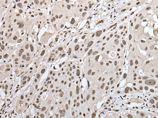 Immunohistochemistry of paraffin-embedded Human esophagus cancer tissue using TA369716 (ZNF43 Antibody) at dilution 1/30 (Original magnification: x200)