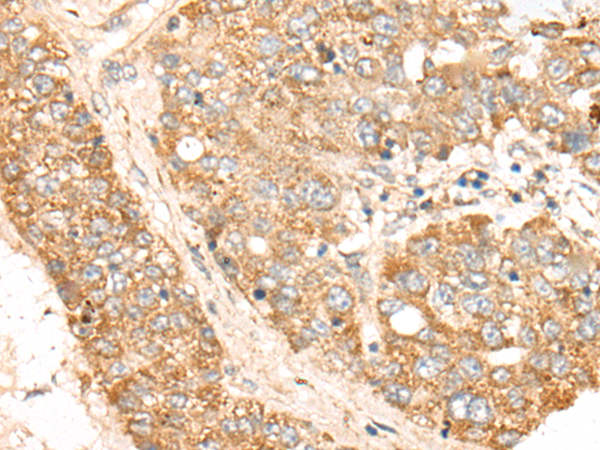 Immunohistochemistry of paraffin-embedded Human liver cancer tissue using TA369733 (TDGF1 Antibody) at dilution 1/30 (Original magnification: x200)