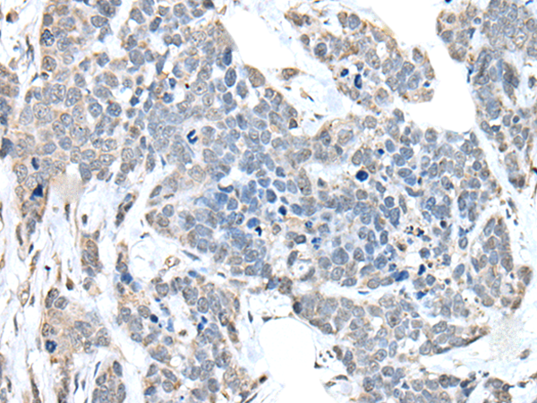 Immunohistochemistry of paraffin-embedded Human thyroid cancer tissue using TA369752 (ANKRD27 Antibody) at dilution 1/30 (Original magnification: x200)