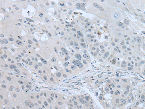 Immunohistochemistry of paraffin-embedded Human esophagus cancer tissue using TA369763 (VWA2 Antibody) at dilution 1/30 (Original magnification: x200)
