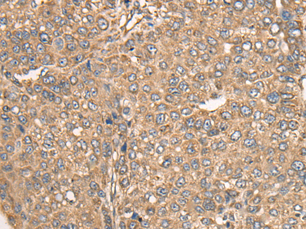 Immunohistochemistry of paraffin-embedded Human liver cancer tissue using TA369827 (BCO2 Antibody) at dilution 1/30 (Original magnification: x200)
