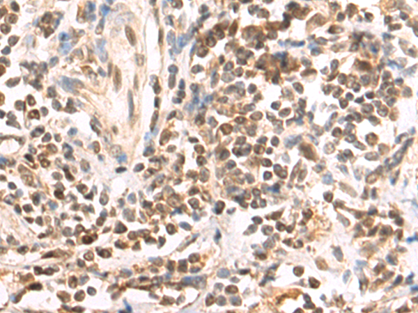 Immunohistochemistry of paraffin-embedded Human gastric cancer tissue using TA369865 (LDLRAD4 Antibody) at dilution 1/70 (Original magnification: x200)