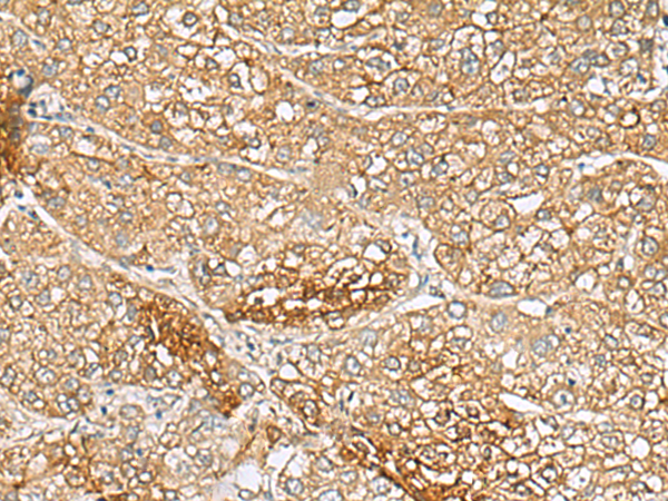 Immunohistochemistry of paraffin-embedded Human liver cancer tissue using TA369873 (C1orf112 Antibody) at dilution 1/110 (Original magnification: x200)