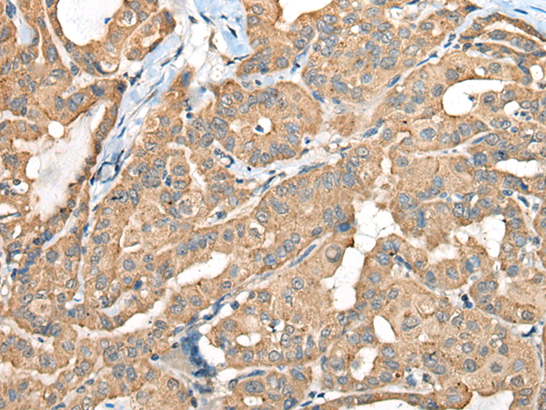 Immunohistochemistry of paraffin-embedded Human thyroid cancer tissue using TA369889 (CA6 Antibody) at dilution 1/35 (Original magnification: x200)