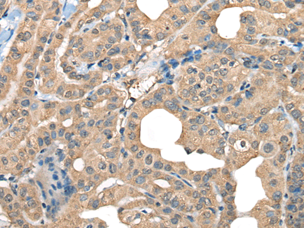 Immunohistochemistry of paraffin-embedded Human thyroid cancer tissue using TA369891 (CABP5 Antibody) at dilution 1/65 (Original magnification: x200)