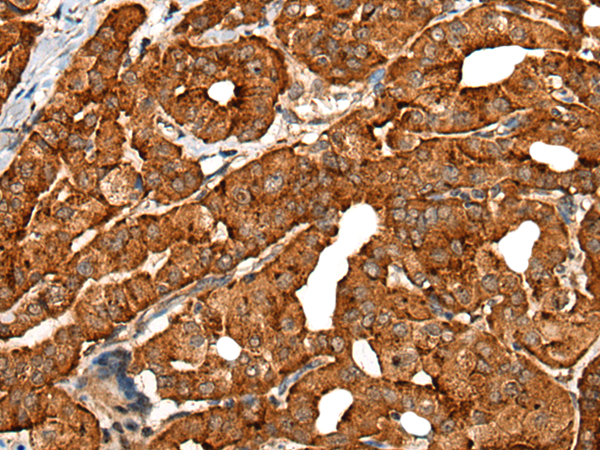 Immunohistochemistry of paraffin-embedded Human thyroid cancer tissue using TA369893 (CDH16 Antibody) at dilution 1/30 (Original magnification: x200)