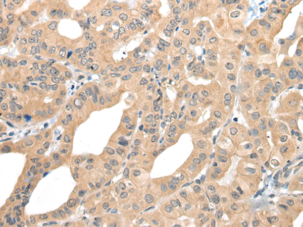 Immunohistochemistry of paraffin-embedded Human thyroid cancer tissue using TA369894 (CAGE1 Antibody) at dilution 1/35 (Original magnification: x200)