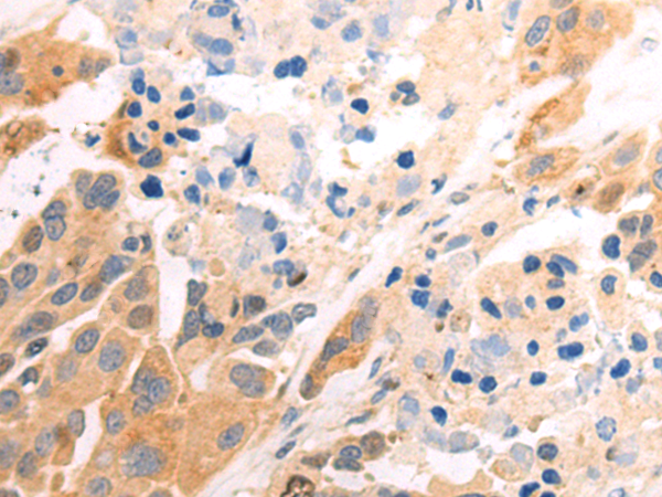 Immunohistochemistry of paraffin-embedded Human colorectal cancer tissue using TA369918 (CCDC120 Antibody) at dilution 1/85 (Original magnification: x200)