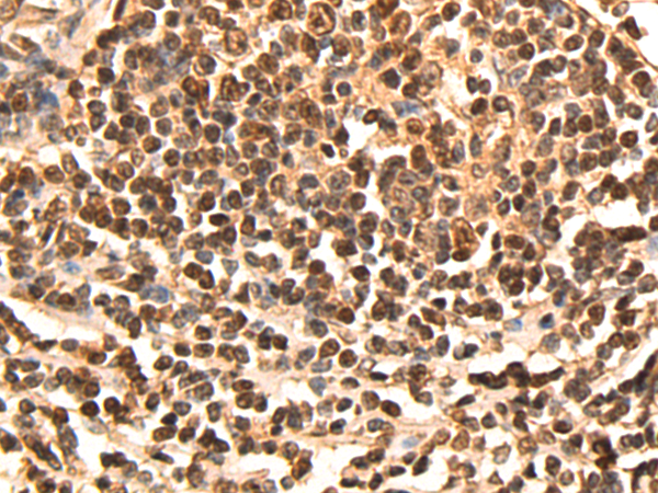 Immunohistochemistry of paraffin-embedded Human gastric cancer tissue using TA369938 (CDCA5 Antibody) at dilution 1/60 (Original magnification: x200)