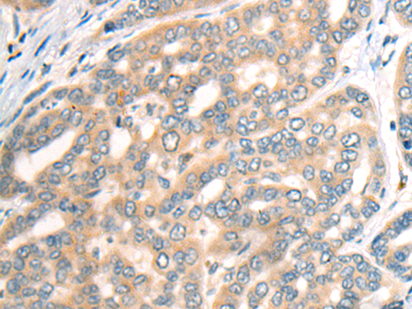 Immunohistochemistry of paraffin-embedded Human liver cancer tissue using TA369939 (CDH19 Antibody) at dilution 1/35 (Original magnification: x200)