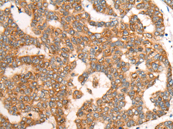 Immunohistochemistry of paraffin-embedded Human liver cancer tissue using TA369944 (CDON Antibody) at dilution 1/65 (Original magnification: x200)
