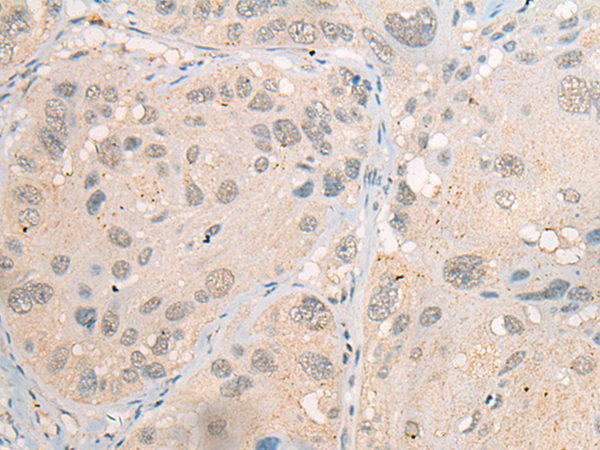 Immunohistochemistry of paraffin-embedded Human esophagus cancer tissue using TA369946 (CDYL2 Antibody) at dilution 1/20 (Original magnification: x200)