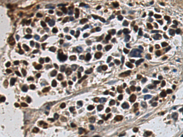 Immunohistochemistry of paraffin-embedded Human breast cancer tissue using TA369994 (CLK4 Antibody) at dilution 1/170 (Original magnification: x200)