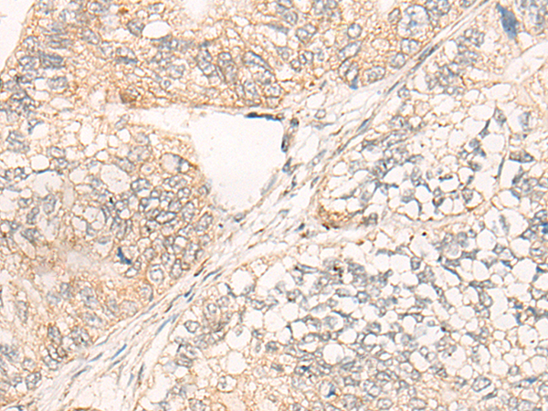 Immunohistochemistry of paraffin-embedded Human gastric cancer tissue using TA370007 (COG5 Antibody) at dilution 1/20 (Original magnification: x200)