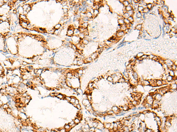 Immunohistochemistry of paraffin-embedded Human thyroid cancer tissue using TA370024 (ABCC6 Antibody) at dilution 1/20 (Original magnification: x200)