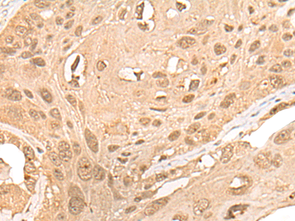 Immunohistochemistry of paraffin-embedded Human esophagus cancer tissue using TA370034 (CPNE7 Antibody) at dilution 1/20 (Original magnification: x200)