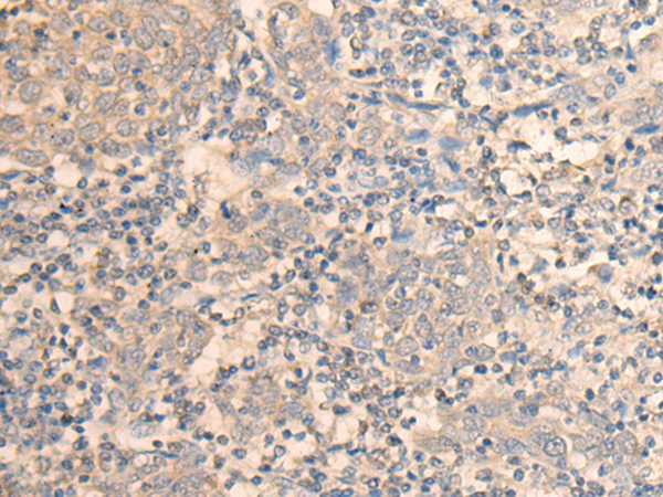 Immunohistochemistry of paraffin-embedded Human cervical cancer tissue using TA370062 (DAZ1 Antibody) at dilution 1/55 (Original magnification: x200)