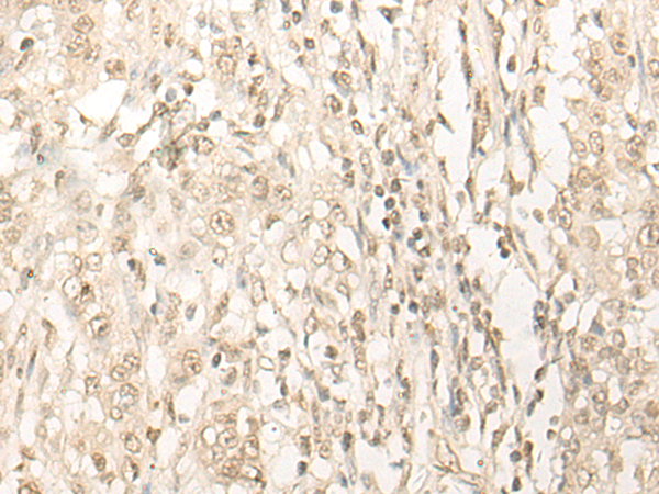 Immunohistochemistry of paraffin-embedded Human colorectal cancer tissue using TA370083 (DDX52 Antibody) at dilution 1/20 (Original magnification: x200)