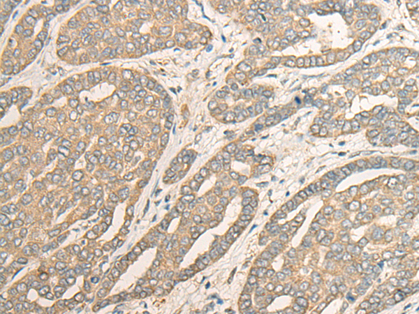 Immunohistochemistry of paraffin-embedded Human liver cancer tissue using TA370097 (MYOZ2 Antibody) at dilution 1/40 (Original magnification: x200)