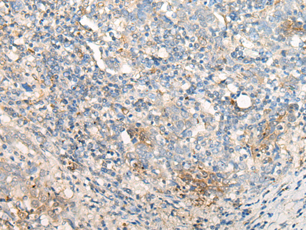Immunohistochemistry of paraffin-embedded Human cervical cancer tissue using TA370102 (CELA3A Antibody) at dilution 1/20 (Original magnification: x200)