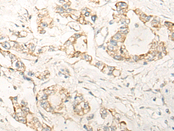 Immunohistochemistry of paraffin-embedded Human gastric cancer tissue using TA370129 (KCTD17 Antibody) at dilution 1/20 (Original magnification: x200)