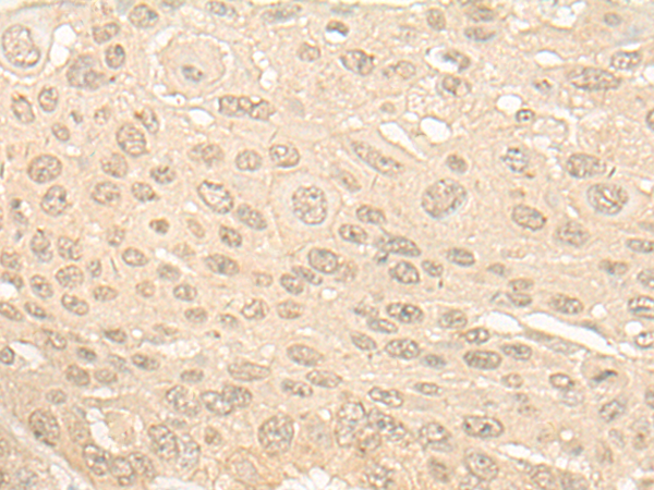 Immunohistochemistry of paraffin-embedded Human esophagus cancer tissue using TA370135 (SLFN5 Antibody) at dilution 1/20 (Original magnification: x200)
