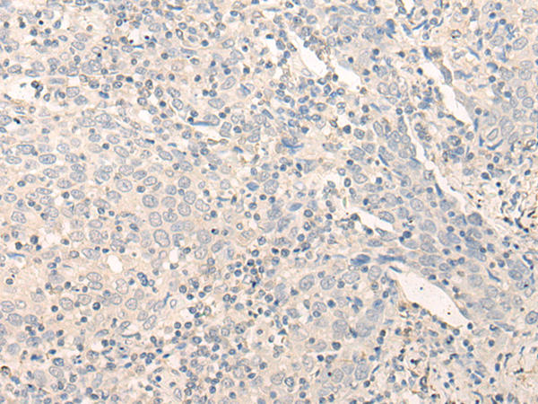 Immunohistochemistry of paraffin-embedded Human cervical cancer tissue using TA370155 (RADIL Antibody) at dilution 1/40 (Original magnification: x200)