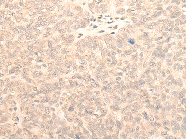 Immunohistochemistry of paraffin-embedded Human ovarian cancer tissue using TA370177 (KLHDC2 Antibody) at dilution 1/20 (Original magnification: x200)
