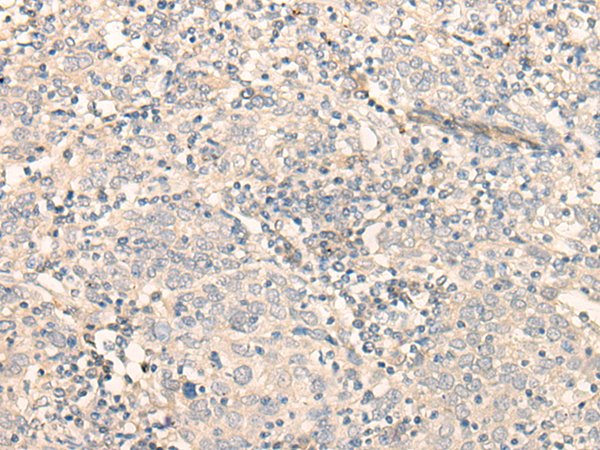 Immunohistochemistry of paraffin-embedded Human cervical cancer tissue using TA370191 (FADS3 Antibody) at dilution 1/20 (Original magnification: x200)