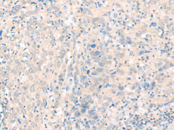 Immunohistochemistry of paraffin-embedded Human cervical cancer tissue using TA370222 (PDZD3 Antibody) at dilution 1/20 (Original magnification: x200)