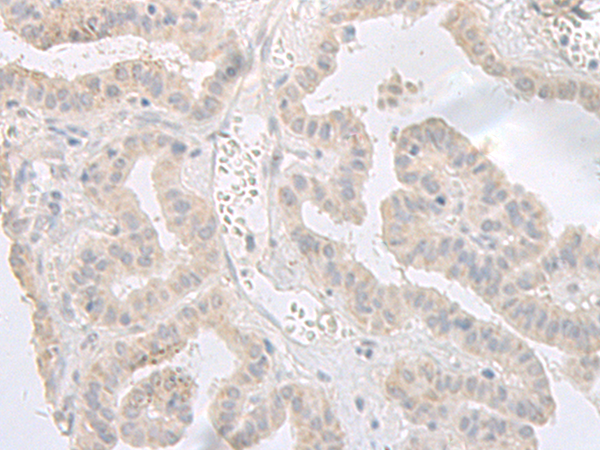 Immunohistochemistry of paraffin-embedded Human thyroid cancer tissue using TA370265 (GPRASP2 Antibody) at dilution 1/35 (Original magnification: x200)
