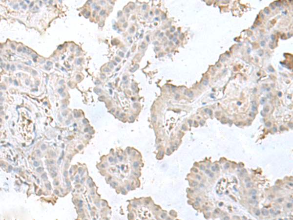 Immunohistochemistry of paraffin-embedded Human thyroid cancer tissue using TA370282 (LSM10 Antibody) at dilution 1/50 (Original magnification: x200)