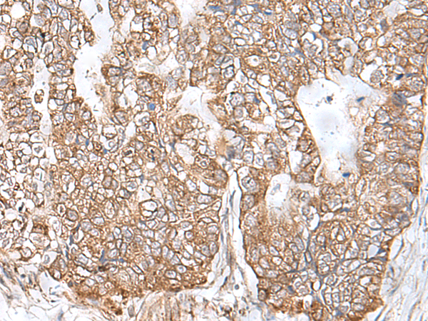 Immunohistochemistry of paraffin-embedded Human gastric cancer tissue using TA370288 (RNF111 Antibody) at dilution 1/50. (Original magnification: x200)