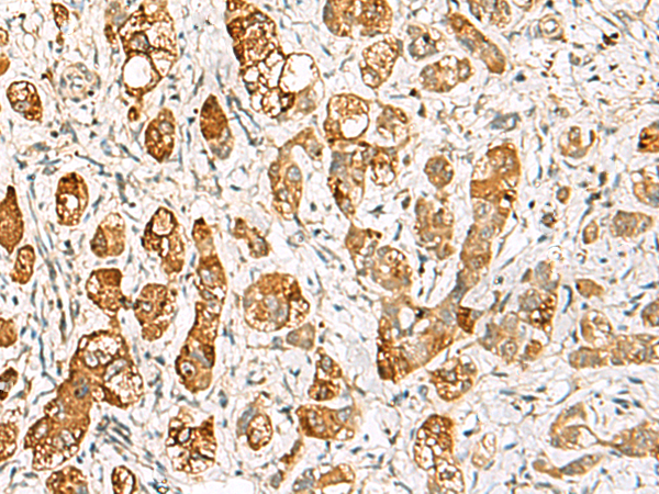 Immunohistochemistry of paraffin-embedded Human liver cancer tissue using TA370357 (RIMS3 Antibody) at dilution 1/60 (Original magnification: x200)