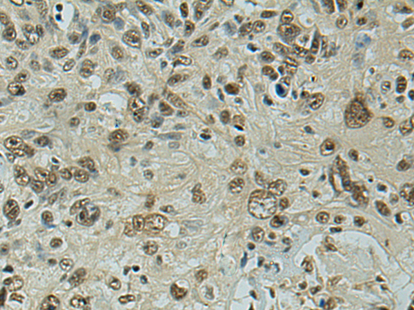 Immunohistochemistry of paraffin-embedded Human esophagus cancer tissue using TA370417 (FSCB Antibody) at dilution 1/100 (Original magnification: x200)