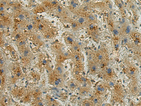 Immunohistochemistry of paraffin-embedded Human liver cancer tissue using TA370418 (ATP6V0A1 Antibody) at dilution 1/150 (Original magnification: x200)