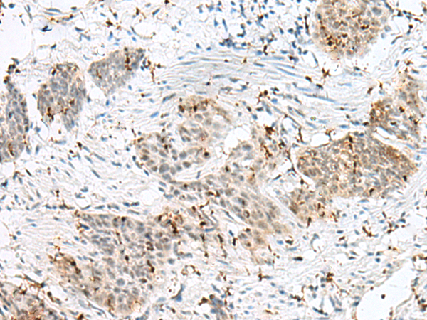 Immunohistochemistry of paraffin-embedded Human esophagus cancer tissue using TA370439 (PLCL2 Antibody) at dilution 1/50 (Original magnification: x200)