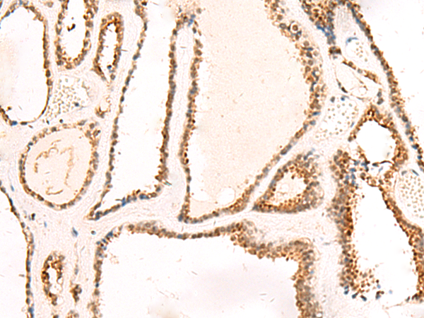 Immunohistochemistry of paraffin-embedded Human thyroid cancer tissue using TA370521 (DCAF10 Antibody) at dilution 1/130 (Original magnification: x200)