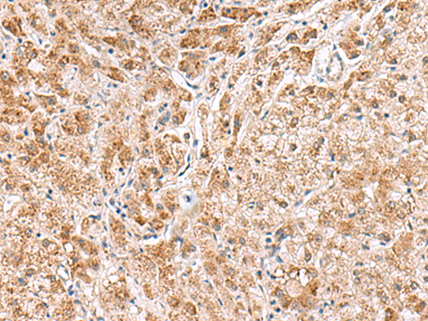 Immunohistochemistry of paraffin-embedded Human liver cancer tissue using TA370572 (HMGCLL1 Antibody) at dilution 1/60 (Original magnification: x200)