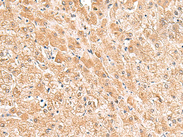 Immunohistochemistry of paraffin-embedded Human liver cancer tissue using TA370576 (TRUB1 Antibody) at dilution 1/85 (Original magnification: x200)