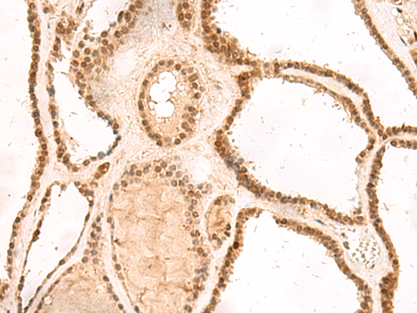 Immunohistochemistry of paraffin-embedded Human thyroid cancer tissue using TA370578 (MKX Antibody) at dilution 1/60 (Original magnification: x200)