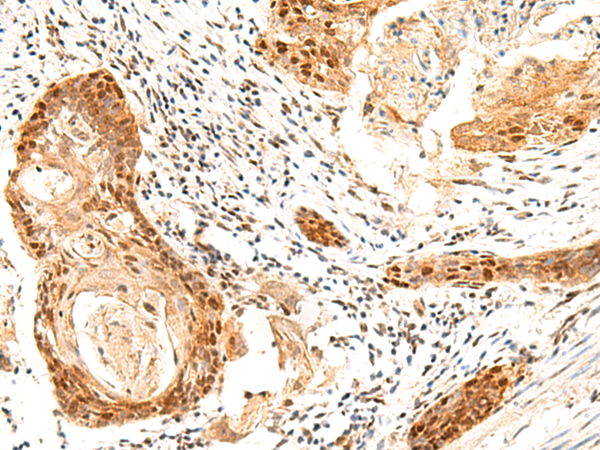 Immunohistochemistry of paraffin-embedded Human esophagus cancer tissue using TA370579 (SETMAR Antibody) at dilution 1/60 (Original magnification: x200)