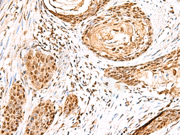 Immunohistochemistry of paraffin-embedded Human esophagus cancer tissue using TA370588 (ELF3 Antibody) at dilution 1/95 (Original magnification: x200)