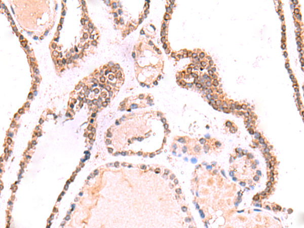 Immunohistochemistry of paraffin-embedded Human thyroid cancer tissue using TA370638 (TOR1AIP1 Antibody) at dilution 1/70 (Original magnification: x200)